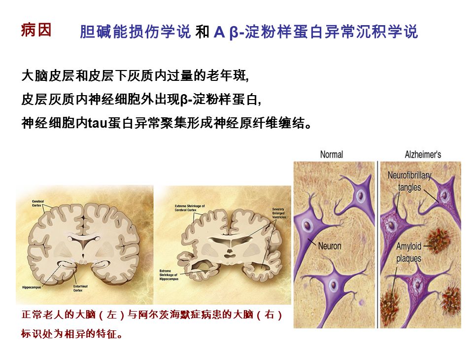 病因 大脑皮层和皮层下灰质内过量的老年斑, 皮层灰质内神经细胞外出现 β- 淀粉样蛋白, 神经细胞内 tau 蛋白异常聚集形成神经原纤维缠结。 正常老人的大脑（左）与阿尔茨海默症病患的大脑（右） 标识处为相异的特征。 胆碱能损伤学说 和 A β- 淀粉样蛋白异常沉积学说