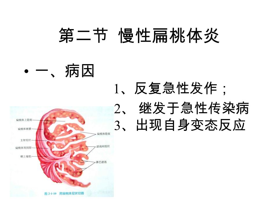第二节 慢性扁桃体炎 一、病因 1 、反复急性发作； 2 、 继发于急性传染病 3 、出现自身变态反应