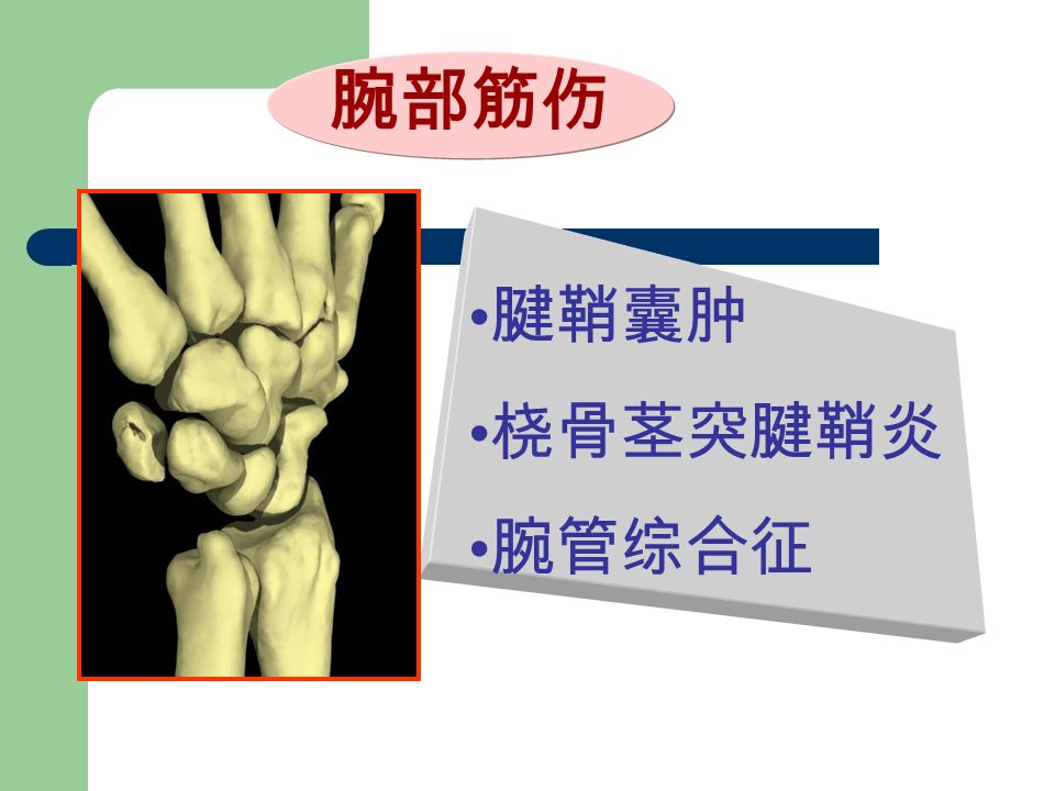 腕部筋伤 腱鞘囊肿 桡骨茎突腱鞘炎 腕管综合征