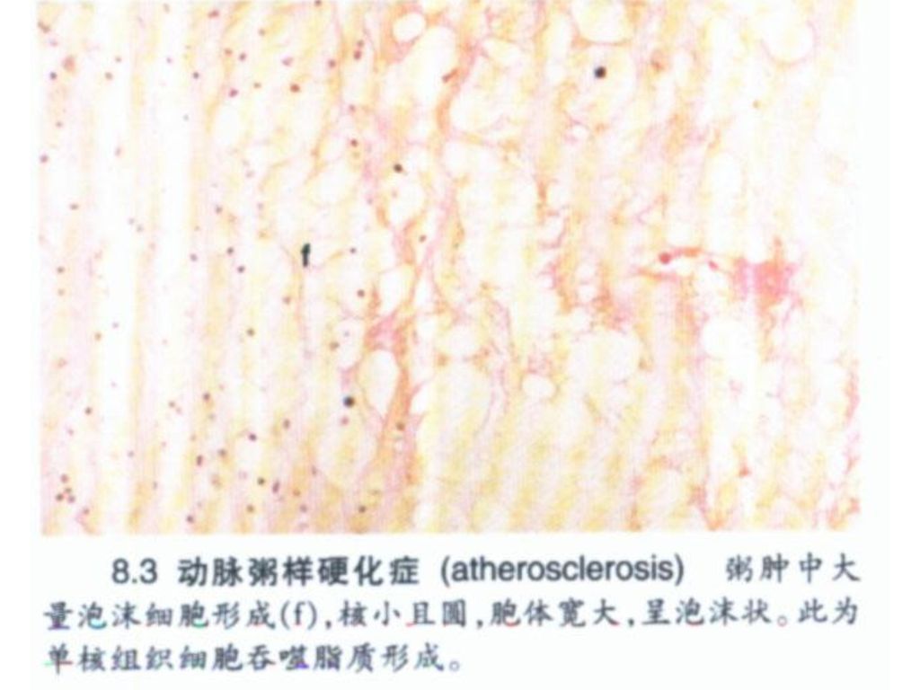 动脉粥样硬化的发病机制 北京大学医学部 病理生理教研室 徐海.