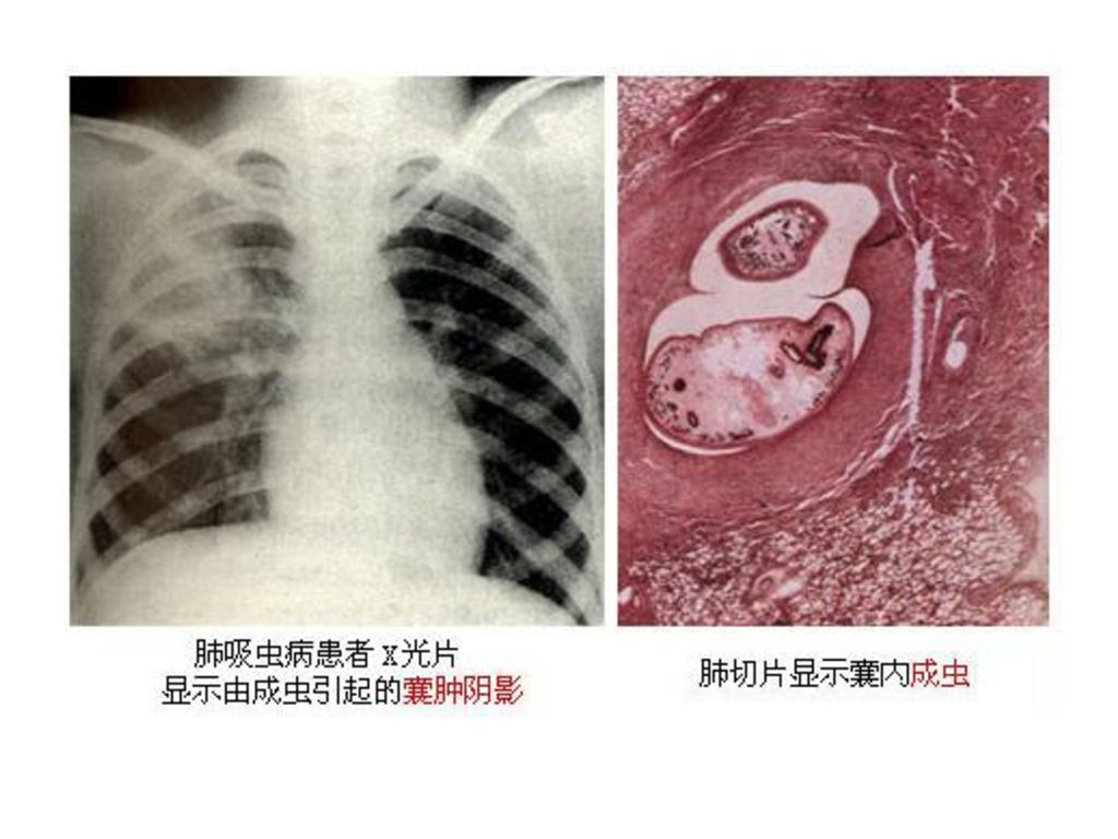 40                胸肺型肺吸虫病胸