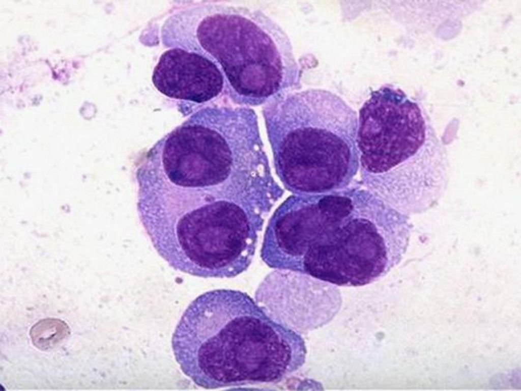 多发性骨髓瘤(multiple myeloma)