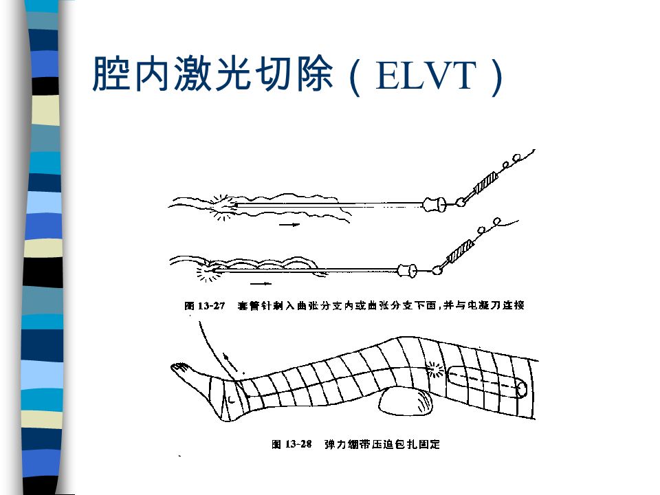 腔内激光切除（ ELVT ）