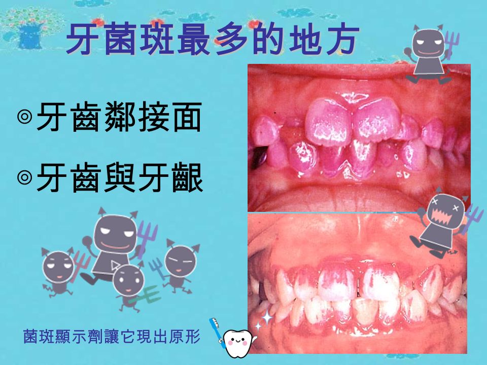 讓蛀牙與牙周病元兇 露出原形的利器 牙菌斑顯示劑