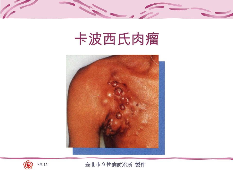 臺北市立性病防治所 製作 卡波西氏肉瘤