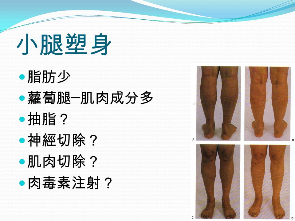 小腿塑身 脂肪少 蘿蔔腿 ─ 肌肉成分多 抽脂？ 神經切除？ 肌肉切除？ 肉毒素注射？