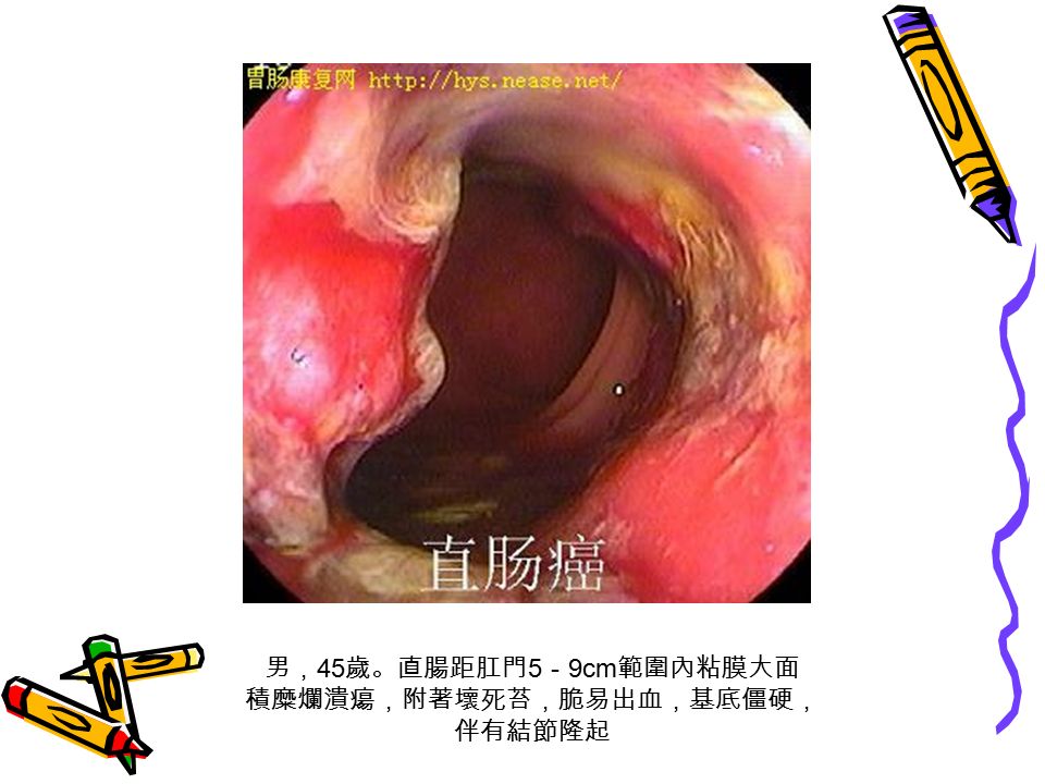 男， 45 歲。直腸距肛門 5 － 9cm 範圍內粘膜大面 積糜爛潰瘍，附著壞死苔，脆易出血，基底僵硬， 伴有結節隆起