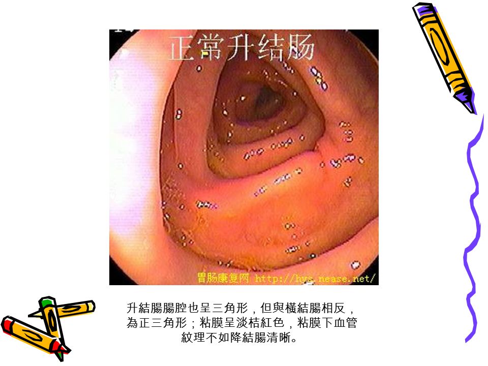 升結腸腸腔也呈三角形，但與橫結腸相反， 為正三角形；粘膜呈淡桔紅色，粘膜下血管 紋理不如降結腸清晰。
