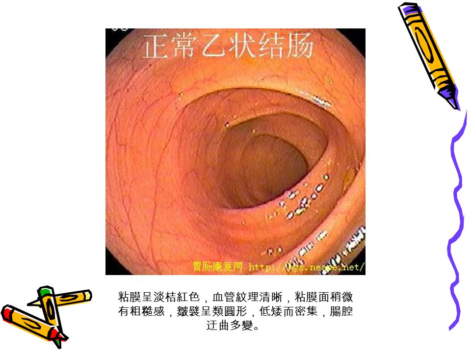 粘膜呈淡桔紅色，血管紋理清晰，粘膜面稍微 有粗糙感，皺襞呈類圓形，低矮而密集，腸腔 迂曲多變。