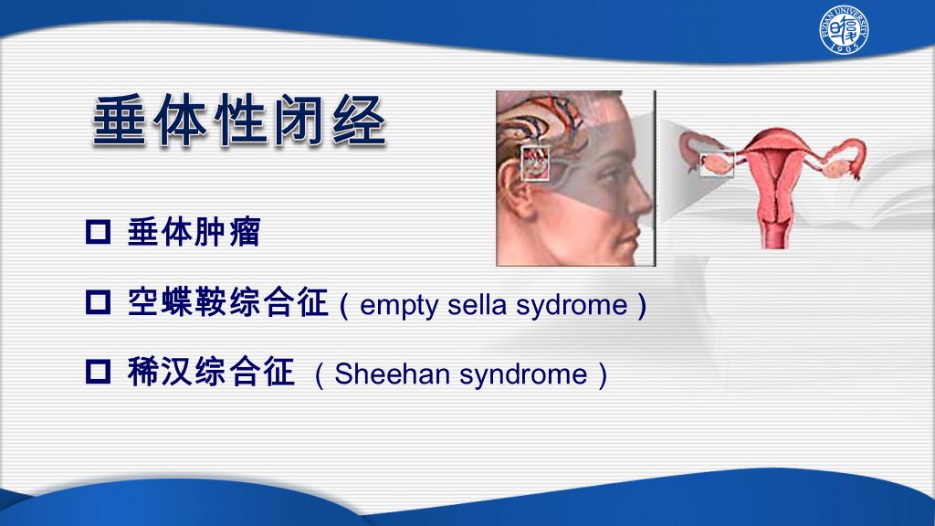 垂体肿瘤  空蝶鞍综合征 （ empty sella sydrome ）  稀汉综合征 （ Sheehan syndrome ）
