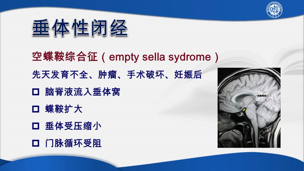 空蝶鞍综合征（ empty sella sydrome ） 先天发育不全、肿瘤、手术破坏、妊娠后  脑脊液流入垂体窝  蝶鞍扩大  垂体受压缩小  门脉循环受阻