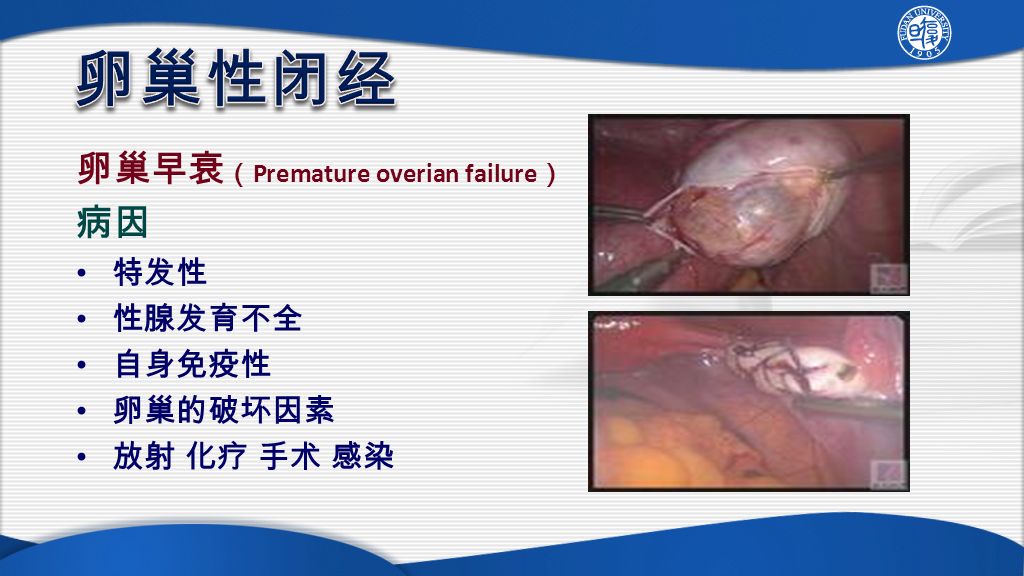 卵巢早衰 （ Premature overian failure ） 病因 特发性 性腺发育不全 自身免疫性 卵巢的破坏因素 放射 化疗 手术 感染
