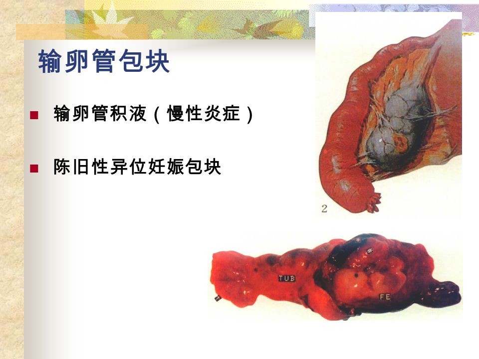 输卵管包块 输卵管积液（慢性炎症） 陈旧性异位妊娠包块