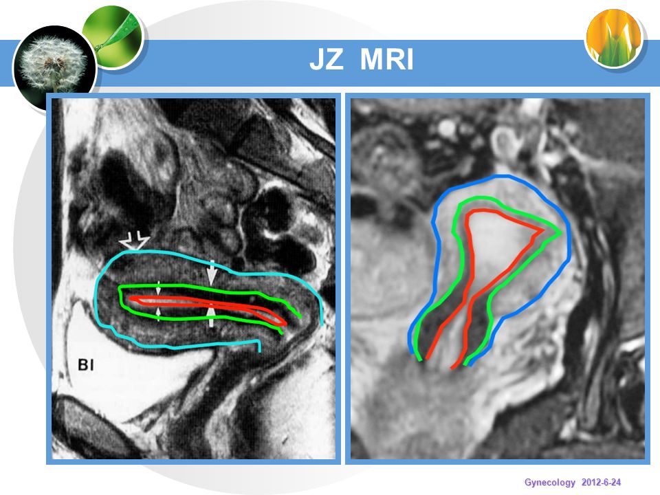 JZ MRI Gynecology