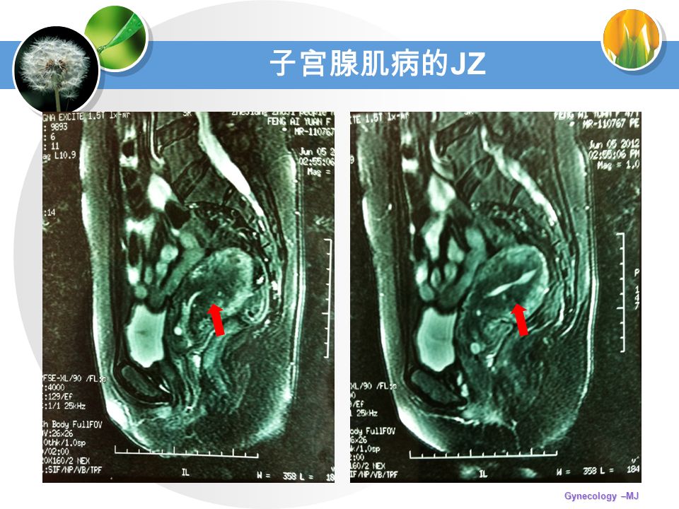 子宫腺肌病的 JZ Gynecology –MJ