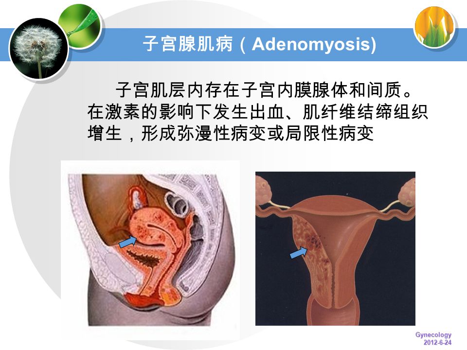 子宫腺肌病（ Adenomyosis) 子宫肌层内存在子宫内膜腺体和间质。 在激素的影响下发生出血、肌纤维结缔组织 增生，形成弥漫性病变或局限性病变 Gynecology