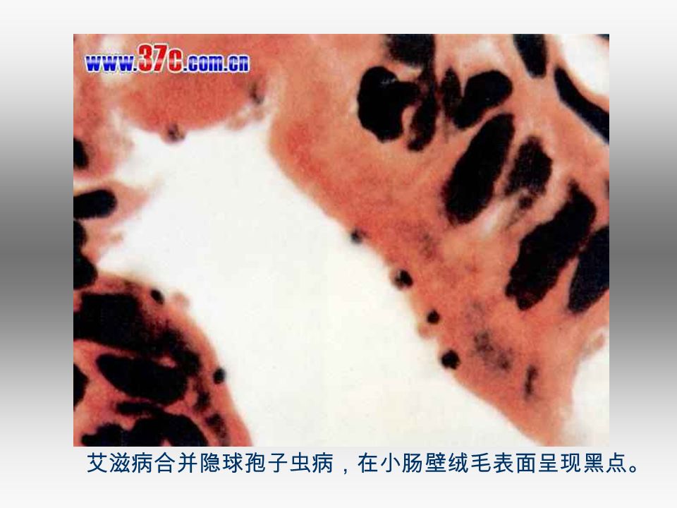 艾滋病合并隐球孢子虫病，在小肠壁绒毛表面呈现黑点。