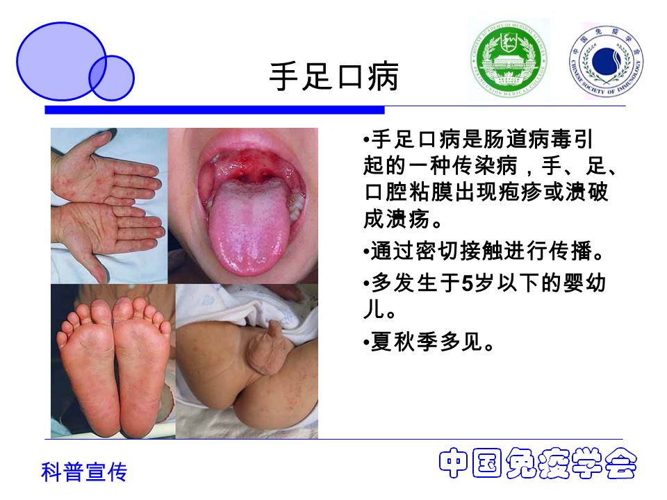 科普宣传 手足口病 手足口病是肠道病毒引 起的一种传染病，手、足、 口腔粘膜出现疱疹或溃破 成溃疡。 通过密切接触进行传播。 多发生于 5 岁以下的婴幼 儿。 夏秋季多见。