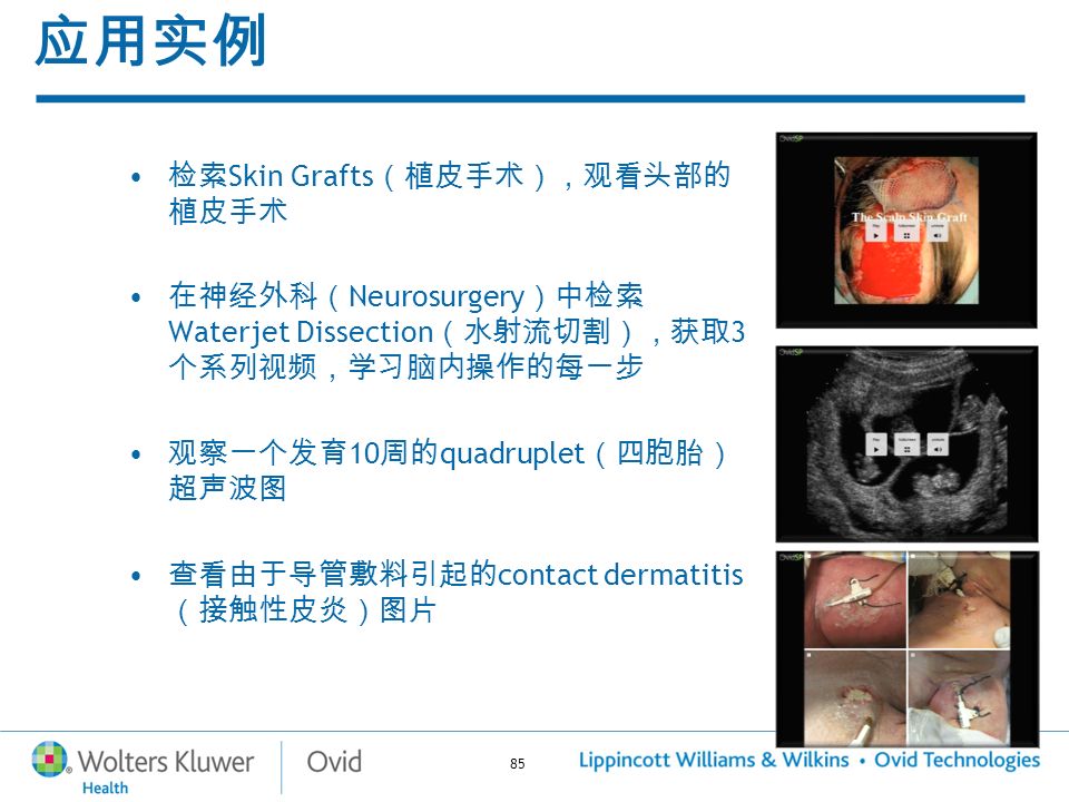 85 应用实例 检索 Skin Grafts （植皮手术），观看头部的 植皮手术 在神经外科（ Neurosurgery ）中检索 Waterjet Dissection （水射流切割），获取 3 个系列视频，学习脑内操作的每一步 观察一个发育 10 周的 quadruplet （四胞胎） 超声波图 查看由于导管敷料引起的 contact dermatitis （接触性皮炎）图片