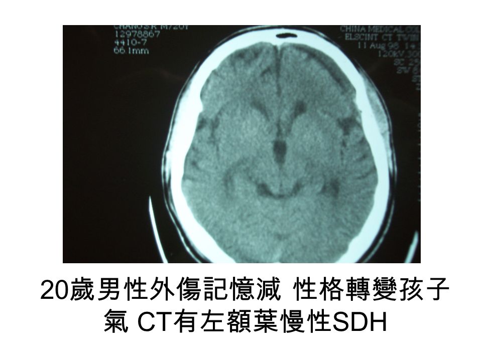 20 歲男性外傷記憶減 性格轉變孩子 氣 CT 有左額葉慢性 SDH