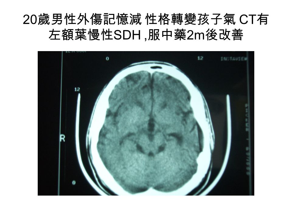 20 歲男性外傷記憶減 性格轉變孩子氣 CT 有 左額葉慢性 SDH, 服中藥 2m 後改善