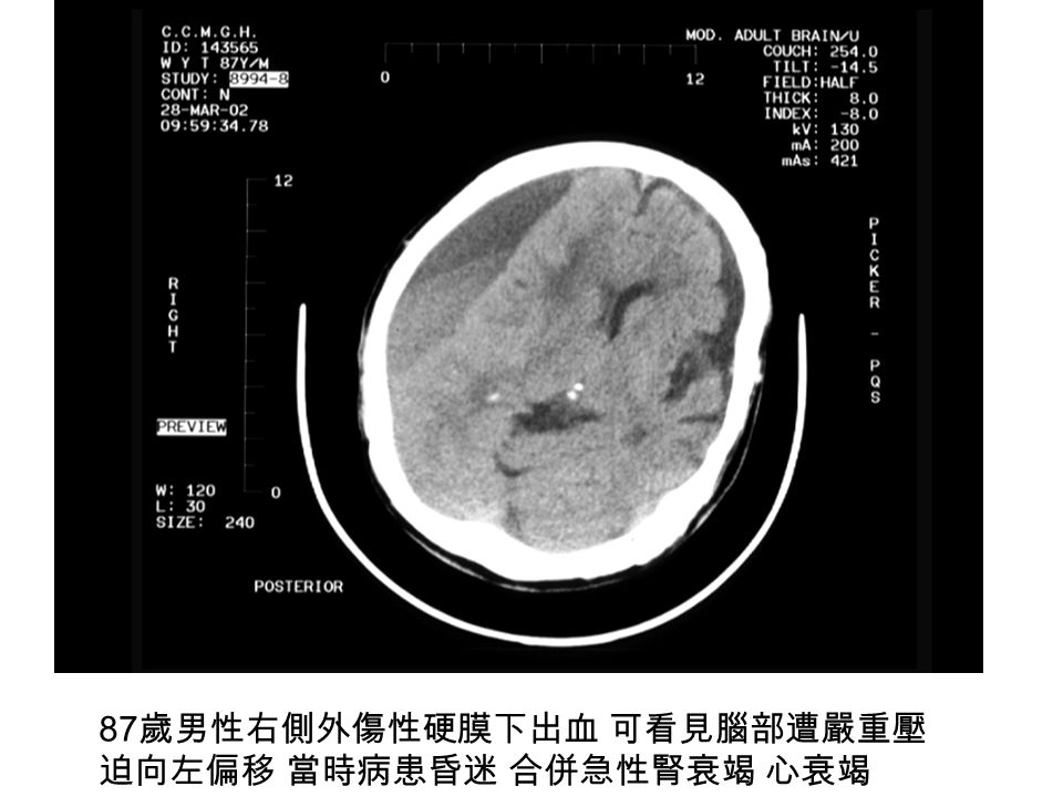 87 歲男性右側外傷性硬膜下出血 可看見腦部遭嚴重壓 迫向左偏移 當時病患昏迷 合併急性腎衰竭 心衰竭
