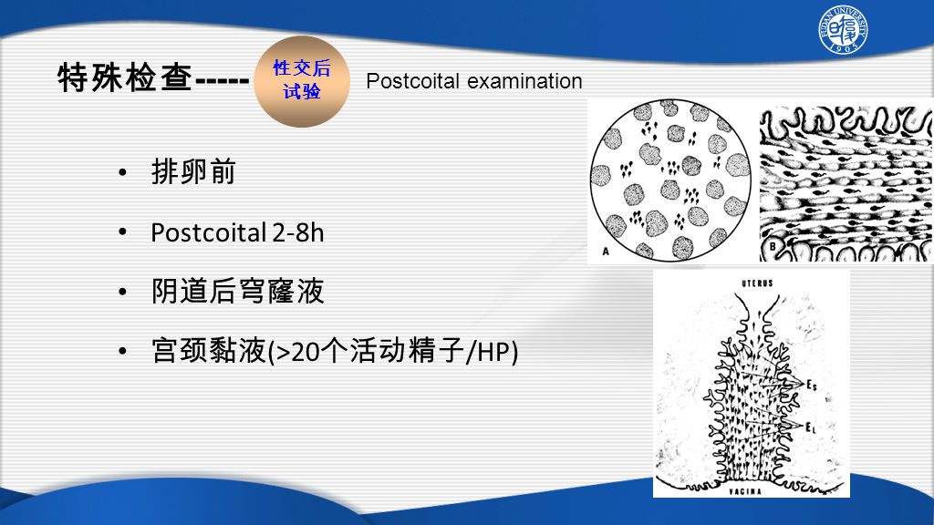 排卵前 Postcoital 2-8h 阴道后穹窿液 宫颈黏液 (>20 个活动精子 /HP) 特殊检查 性交后 试验 Postcoital examination