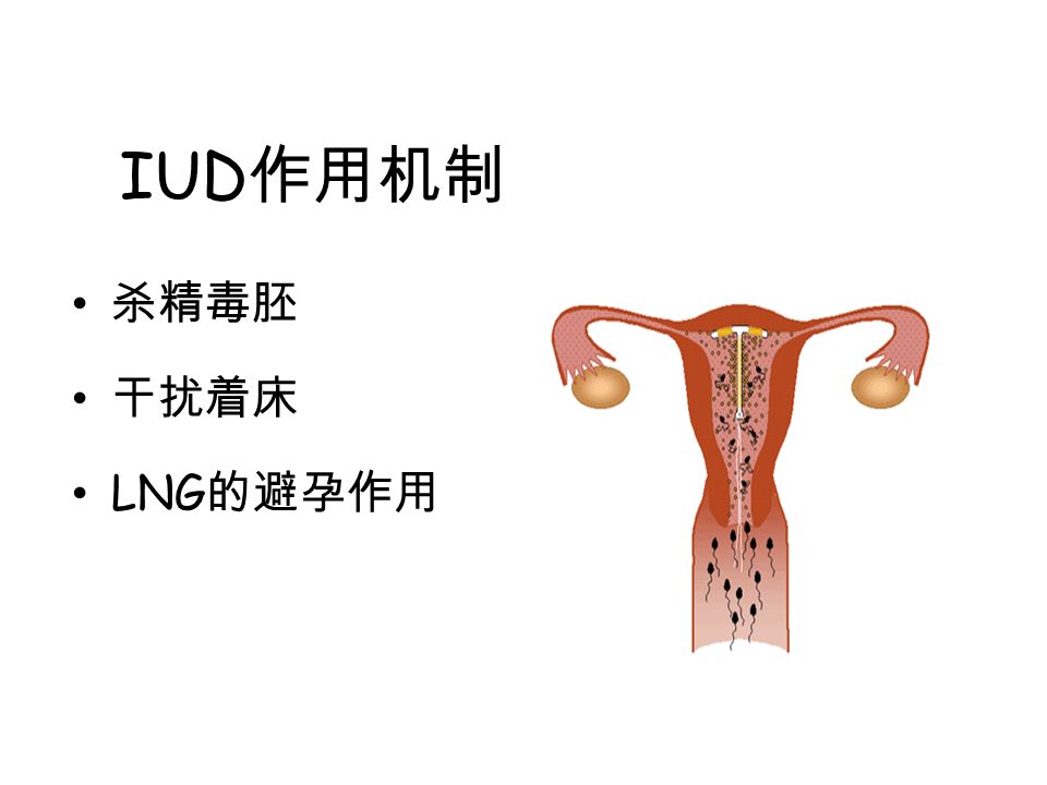 IUD 作用机制 杀精毒胚 干扰着床 LNG 的避孕作用
