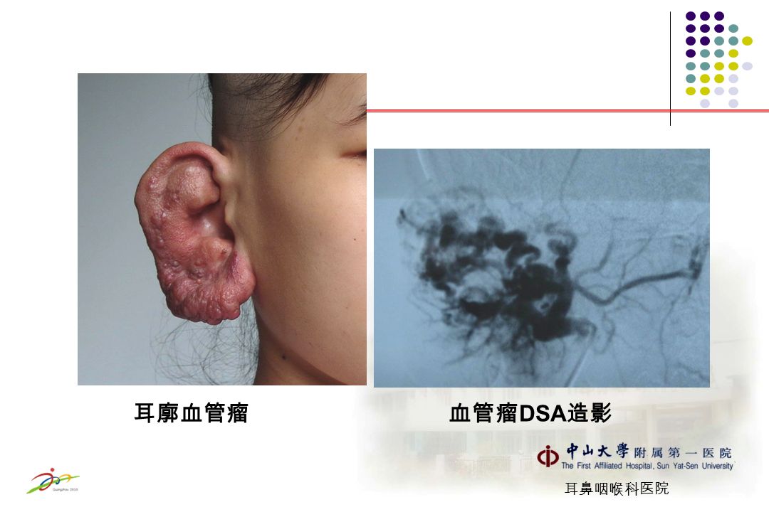 耳鼻咽喉科医院 耳廓血管瘤 血管瘤 DSA 造影