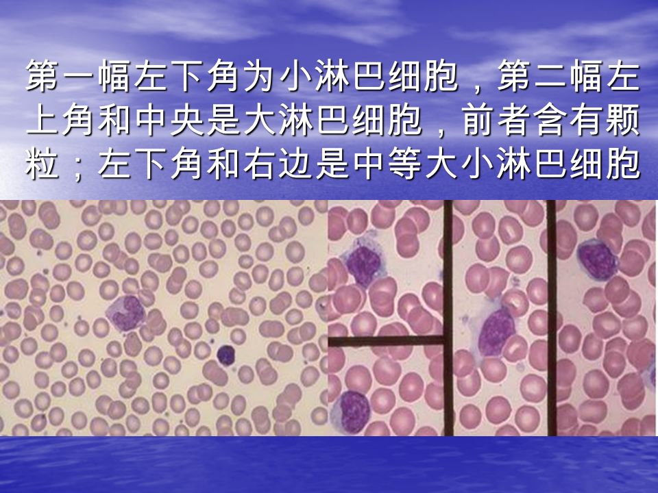 第一幅左下角为小淋巴细胞，第二幅左 上角和中央是大淋巴细胞，前者含有颗 粒；左下角和右边是中等大小淋巴细胞 胞体：直径 15-30μ 不太规则, 为所有原始细 胞 中胞体最大者。 胞核：巨大，圆形或不规则形，核仁 2-3 个，淡兰 色，大小不等，不太明显。 胞浆：量很少，不规则，呈海绵样，深兰色无核 周界，无颗粒但有叶呈泡沫状。 胞体：直径 15-30μ 不太规则, 为所有原始细 胞 中胞体最大者。 胞核：巨大，圆形或不规则形，核仁 2-3 个，淡兰 色，大小不等，不太明显。 胞浆：量很少，不规则，呈海绵样，深兰色无核 周界，无颗粒但有叶呈泡沫状。