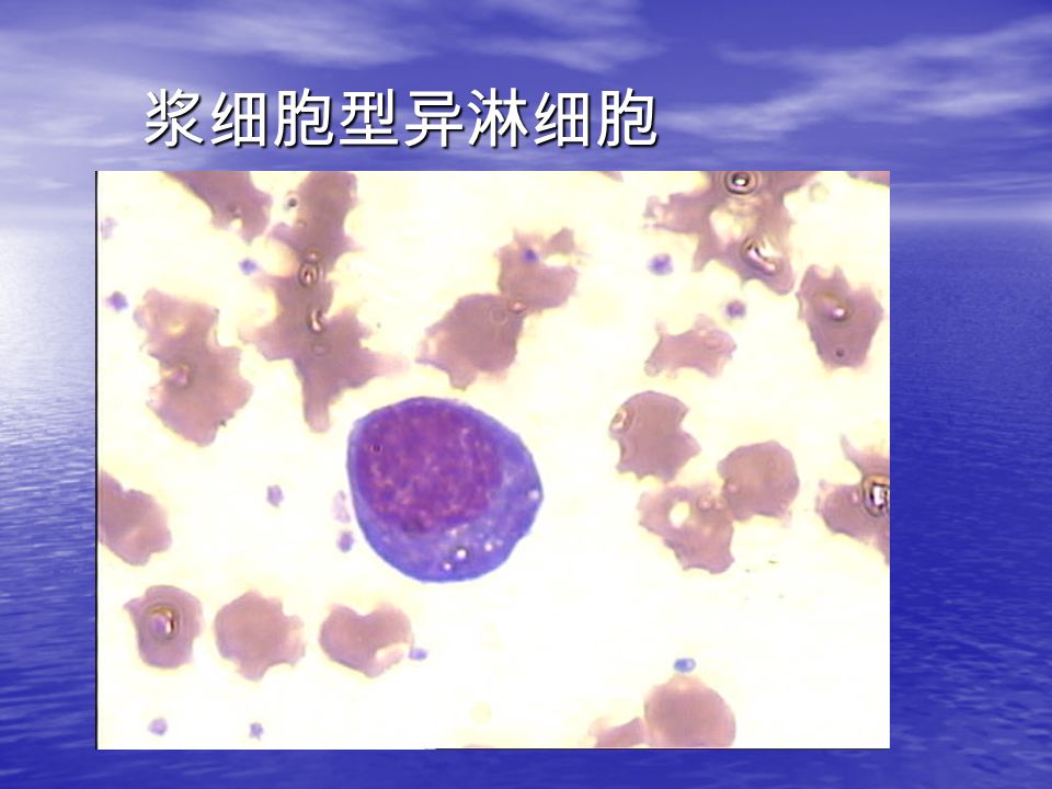 浆细胞型异淋细胞