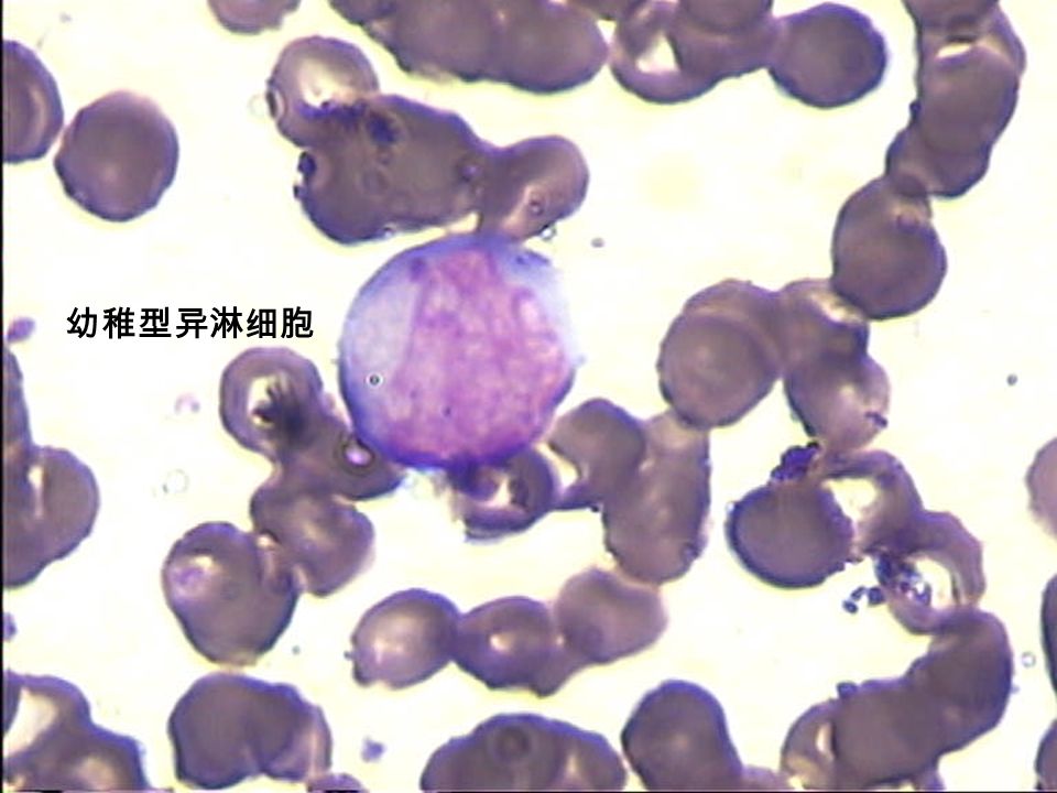 幼稚型异淋细胞