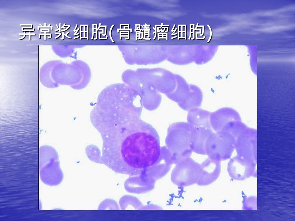异常浆细胞 ( 骨髓瘤细胞 )