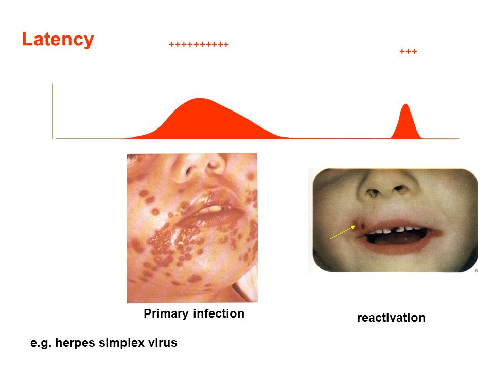 Primary infection reactivation Latency e.g. herpes simplex virus