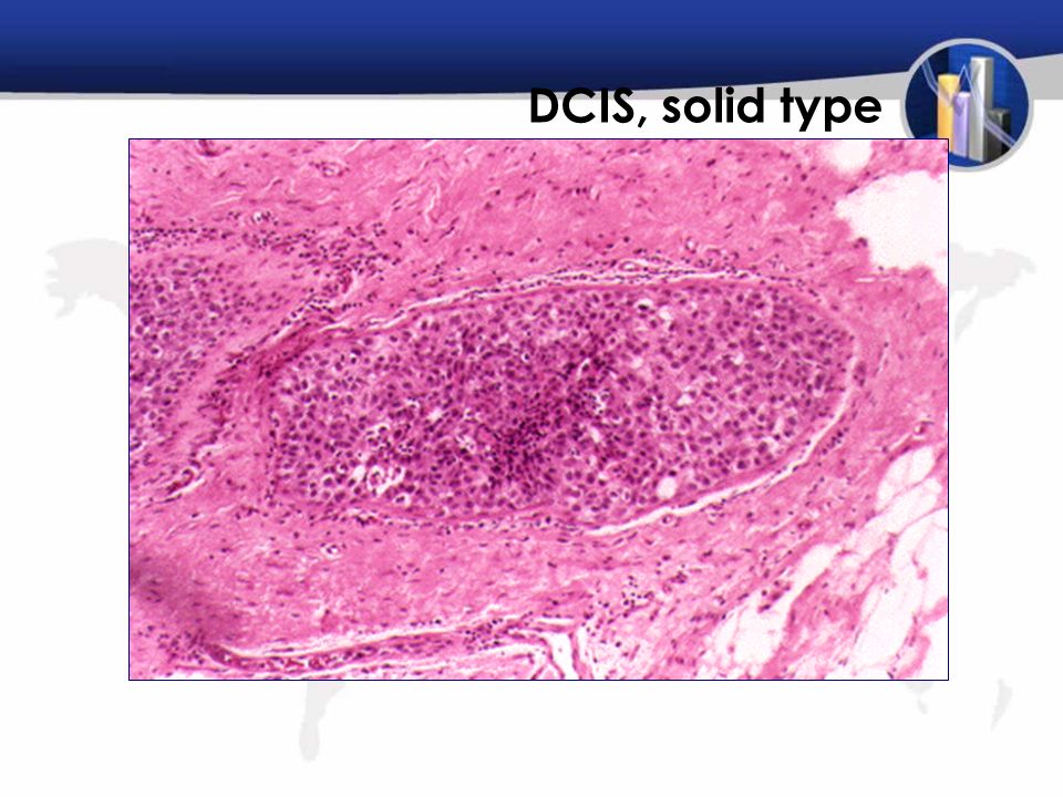 DCIS, solid type