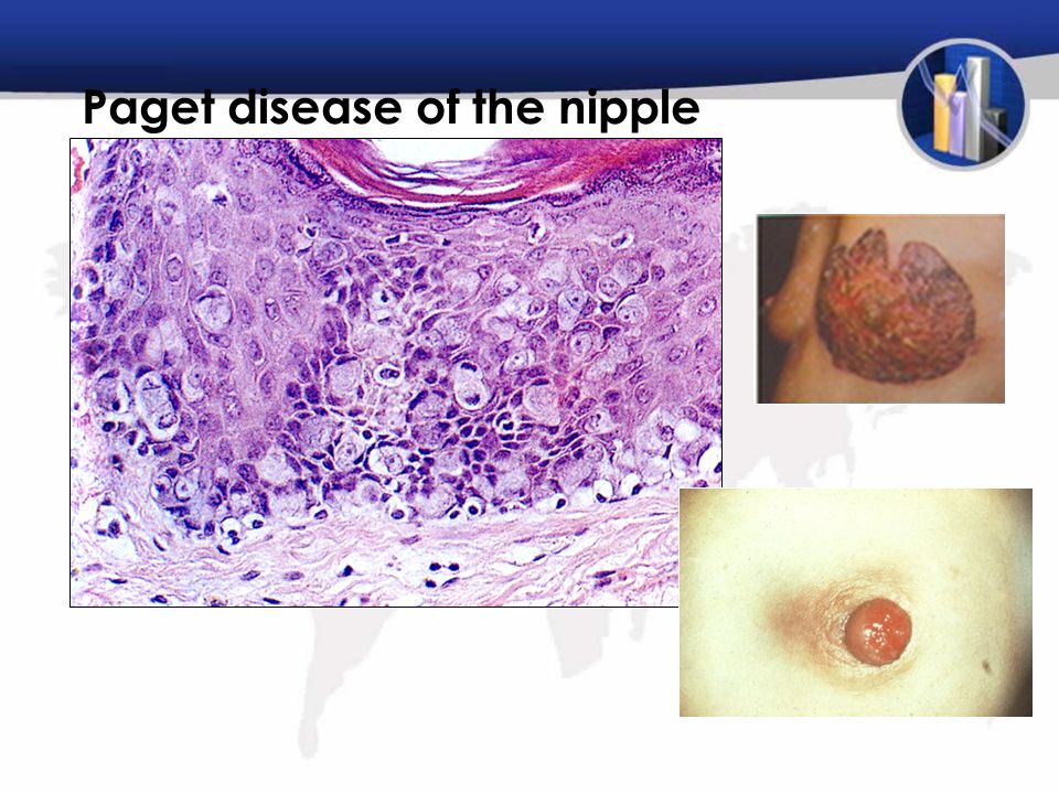 Paget disease of the nipple