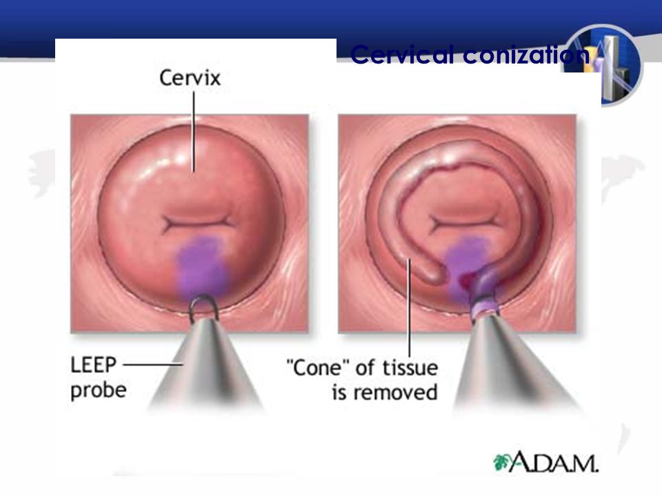 Cervical conization