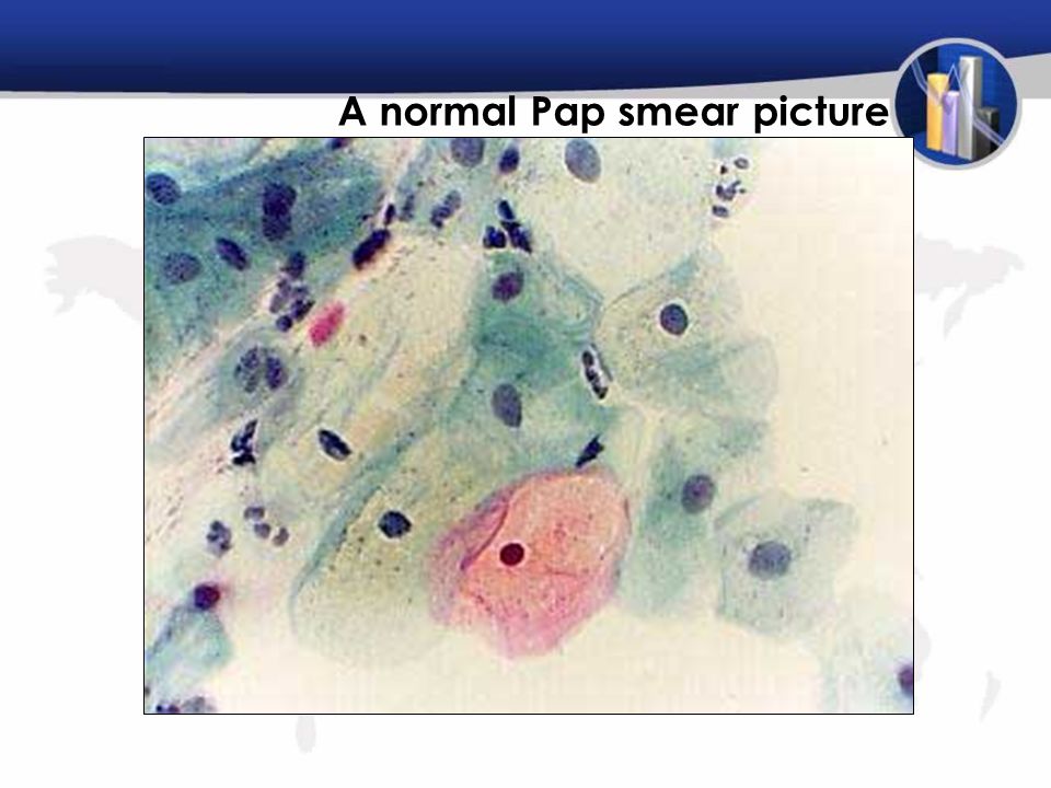 A normal Pap smear picture