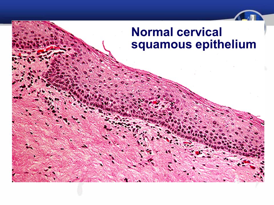 Normal cervical squamous epithelium