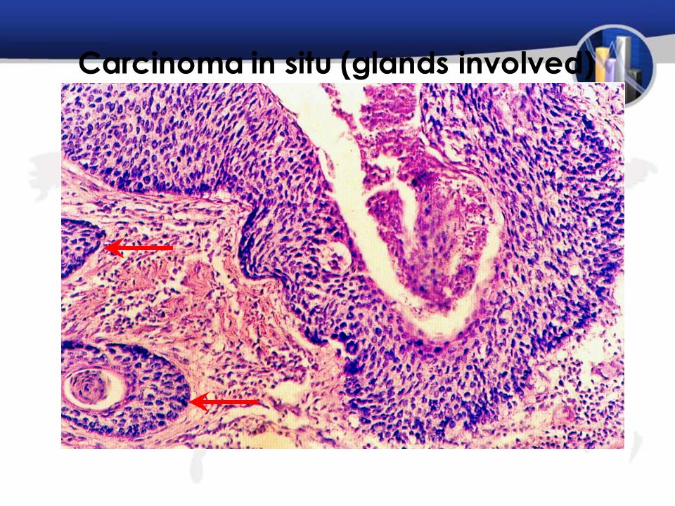 Carcinoma in situ (glands involved)