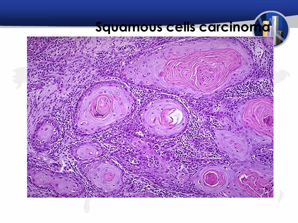 Squamous cells carcinoma