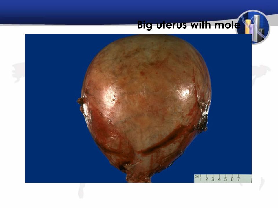 Big uterus with mole