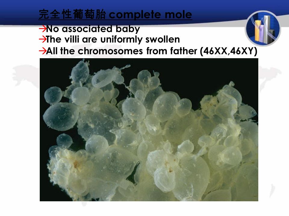完全性葡萄胎 complete mole  No associated baby  The villi are uniformly swollen  All the chromosomes from father (46XX,46XY)