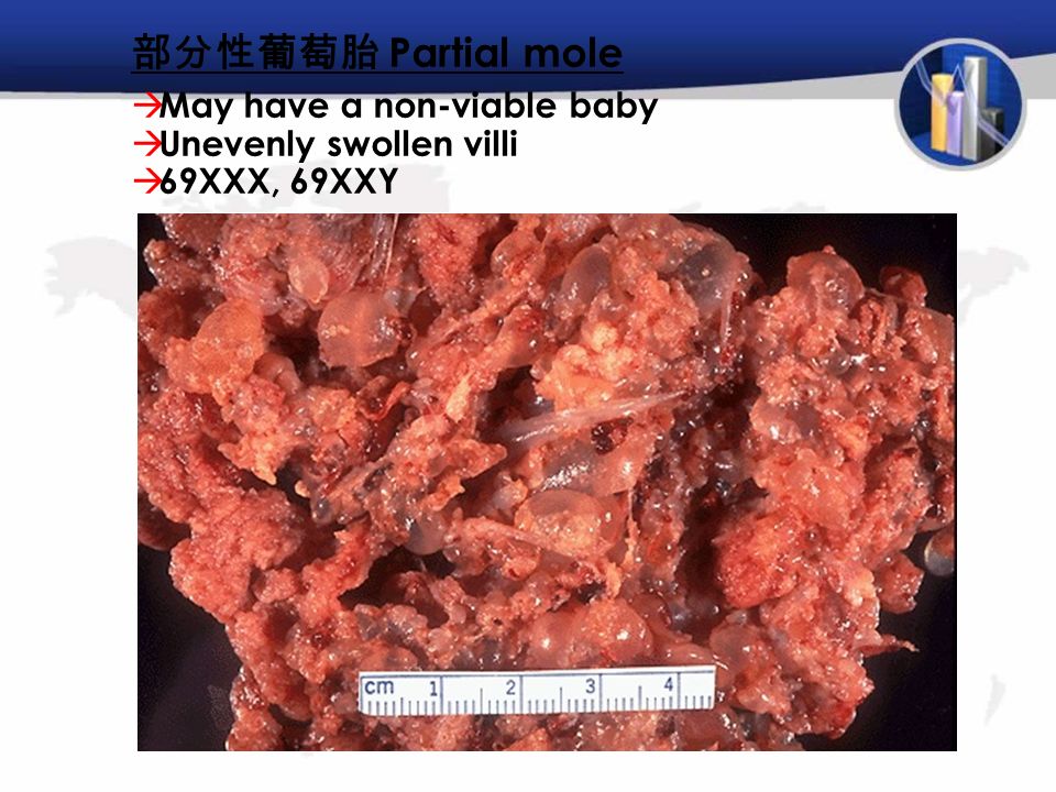 部分性葡萄胎 Partial mole  May have a non-viable baby  Unevenly swollen villi  69XXX, 69XXY