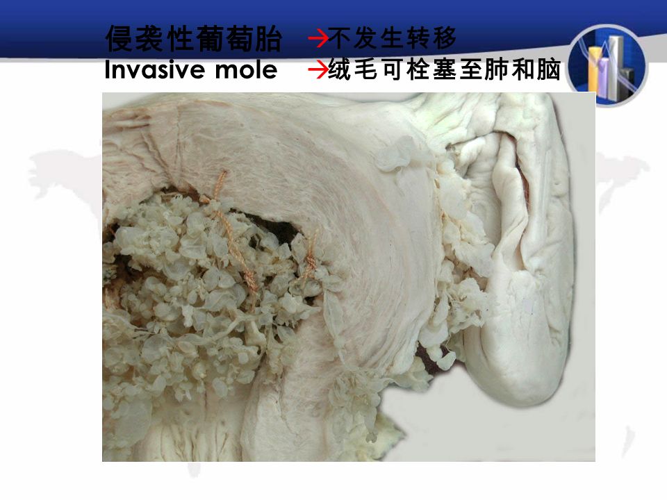 侵袭性葡萄胎 Invasive mole  不发生转移  绒毛可栓塞至肺和脑