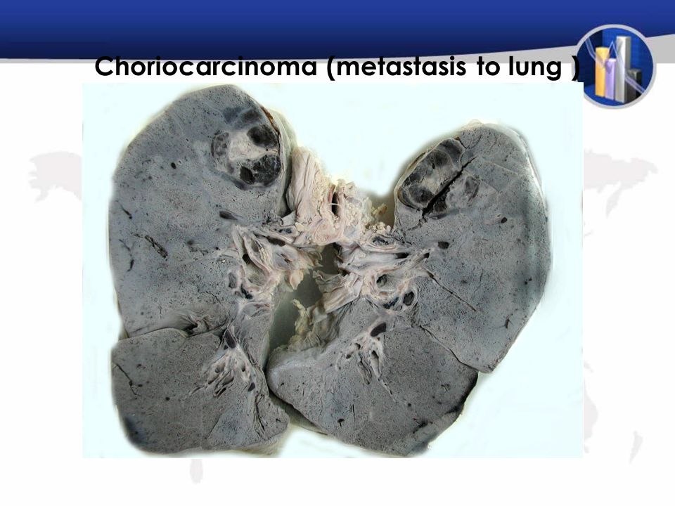 Choriocarcinoma (metastasis to lung )