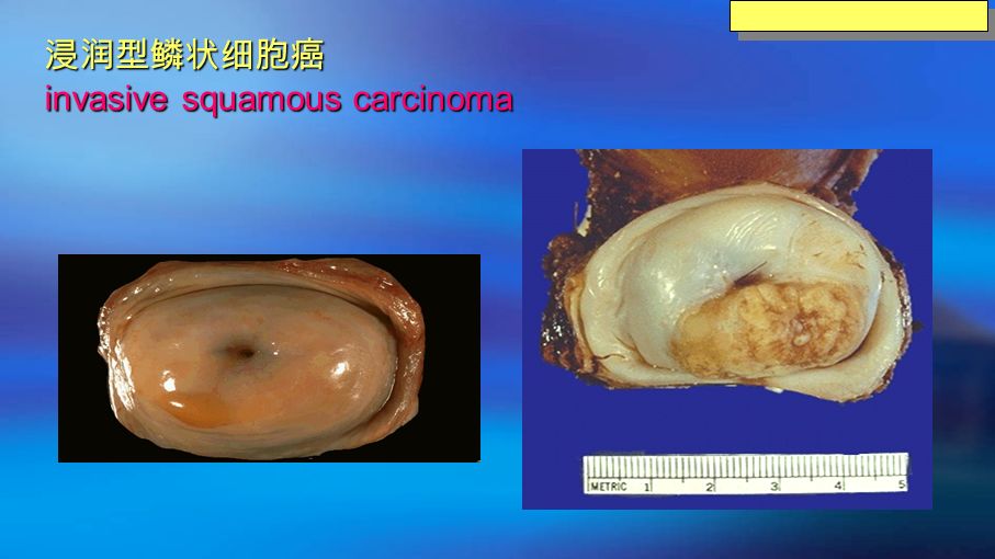 浸润型鳞状细胞癌 invasive squamous carcinoma Cervical diseases