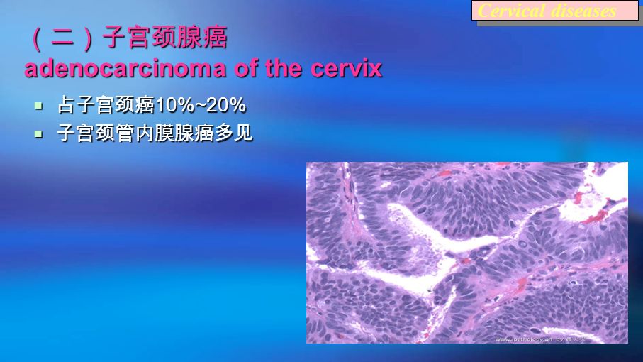 （二）子宫颈腺癌 adenocarcinoma of the cervix  占子宫颈癌 10%~20%  子宫颈管内膜腺癌多见 Cervical diseases
