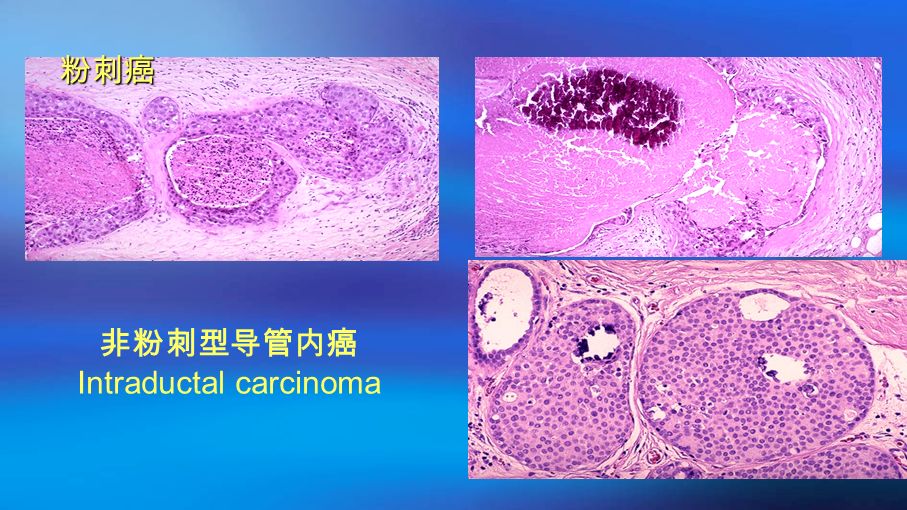 粉刺癌 非粉刺型导管内癌 Intraductal carcinoma