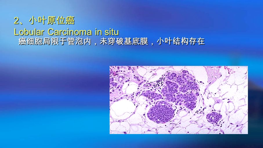 癌细胞局限于管泡内，未穿破基底膜，小叶结构存在 2 、小叶原位癌 Lobular Carcinoma in situ